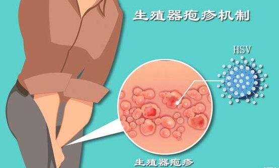 生殖器疱疹护理方法【厦门广肤皮肤病医院】